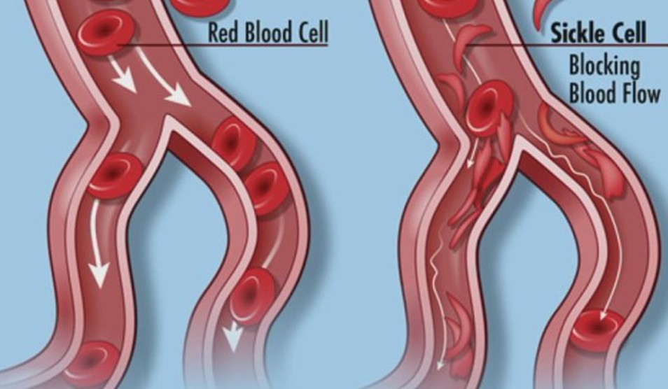 Gene Therapy article