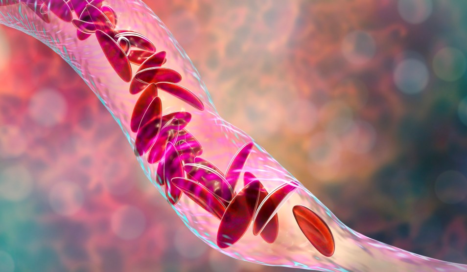 lola sickle_cell_disease blog