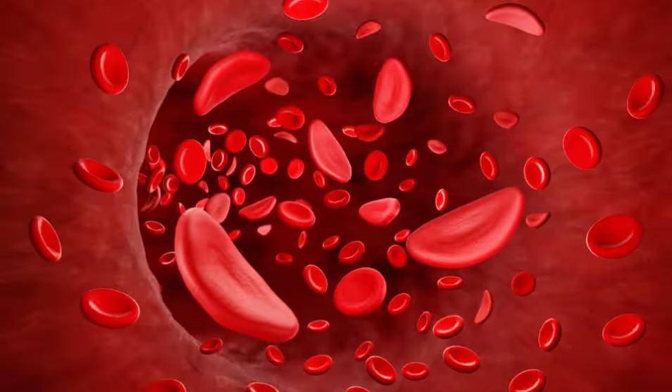 Nigerian sickle love article