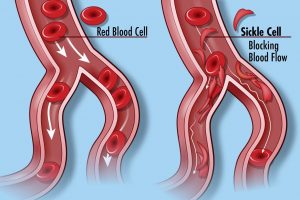 Sickle Cell Blockage