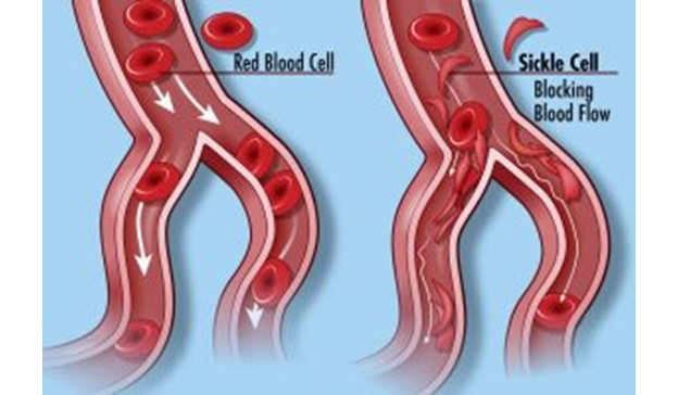 Sickle Cell Blockage