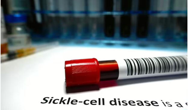 sickle cell blood transfusion article