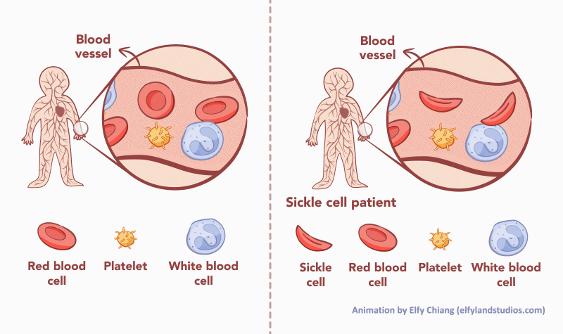 Sicle cell animation